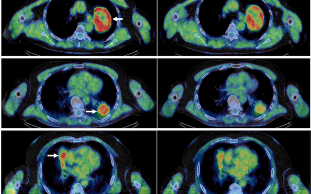 Pre and post atovoquone treatment lung scans in three patients, pre on the left, post on the right. The reduced amount of high intensity red references greater oxygen and thus a reduction in hypoxic environments. 
